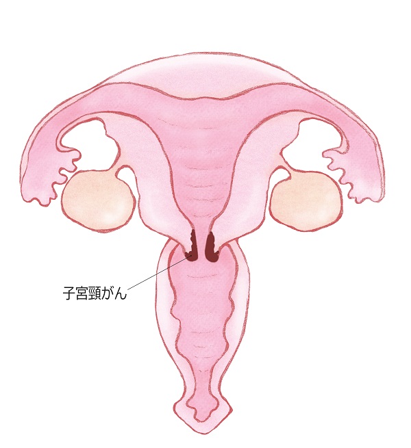 子宮頸がんの原因ってなに？