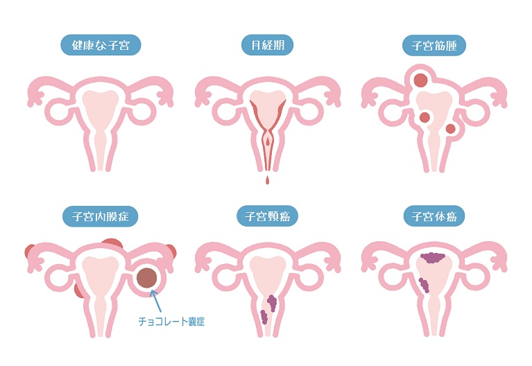 子宮 筋腫 と 子宮 内 膜 症 同時