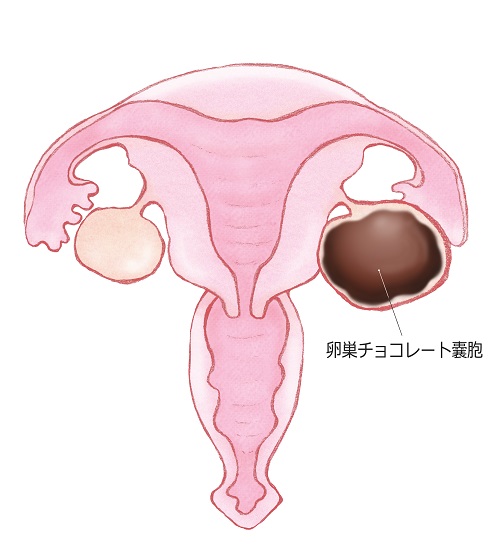 卵巣チョコレートのう腫の治療